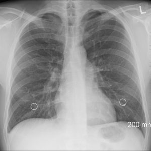 Chest X-Ray